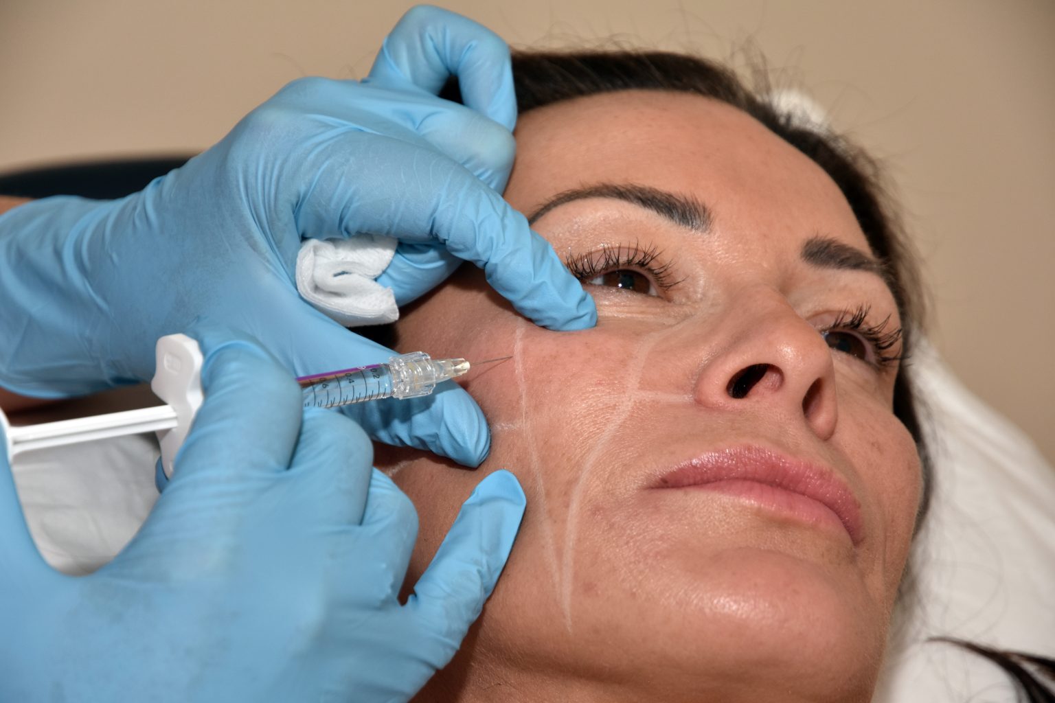 Cheek Fillers The Nightingale Clinic in Petts Wood London